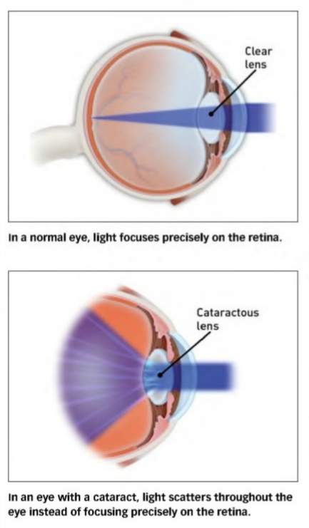 Cataract-Diagram-Screen-Cap-cr