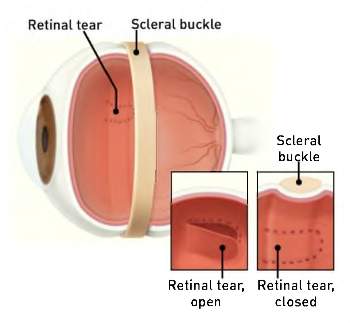 Scleral-Buckle-350x323