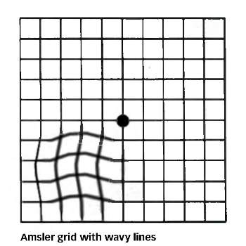 Amsler-Grid-Distorted-350x350