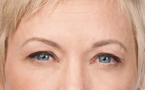 Botox-after-1