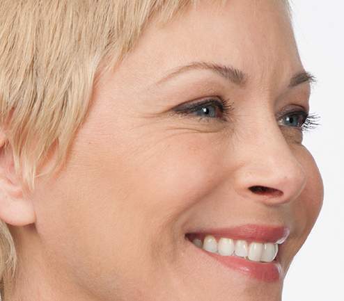 Botox-after-2