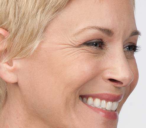 Botox-before-2