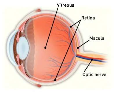 Cystoid-Macular-Edema-400x318