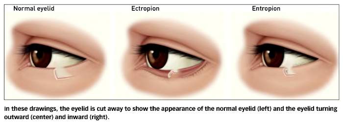 Ectropion-Entropion-Graphic-700x255