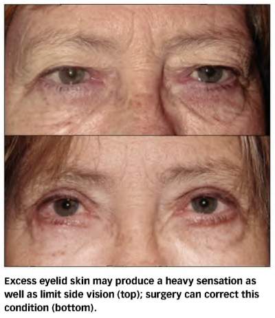 Excess-Eyelid-Skin-400x462