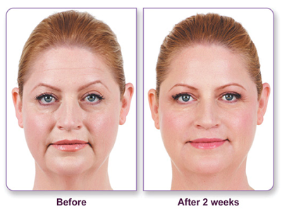Juvederm-400x300