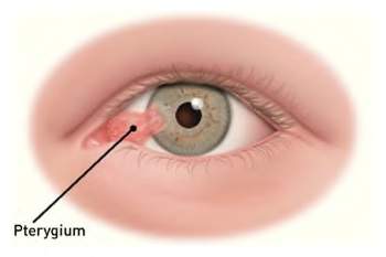 Pterygium-300x233