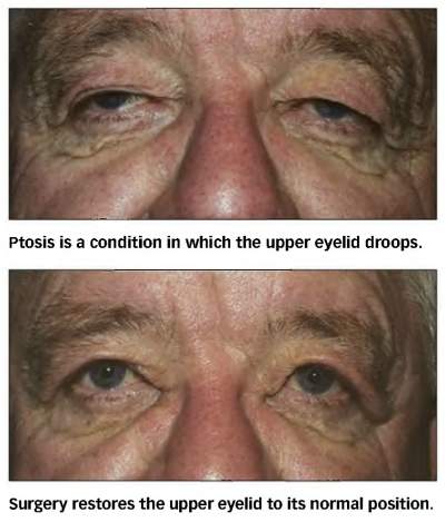 Eyelid Surgery