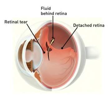 Torn-Retina-350x319