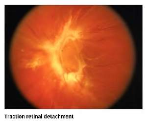 Traction-Retinal-Detachment-300x247