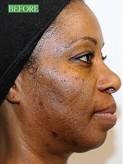 Vi-Peel-4-before