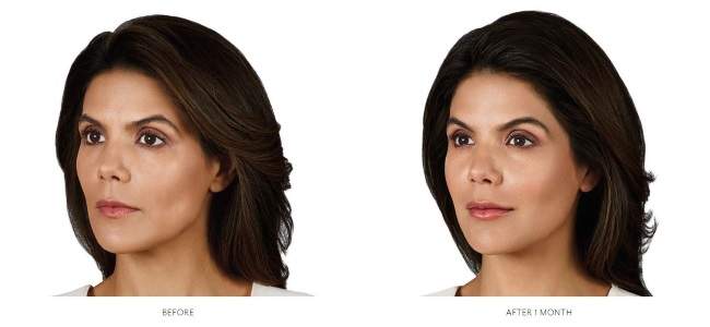 Volbella-BA-650x300