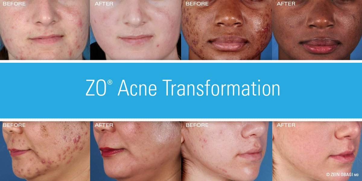acne-banner