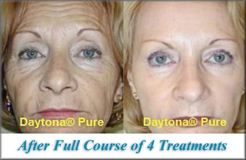 microneedling-2